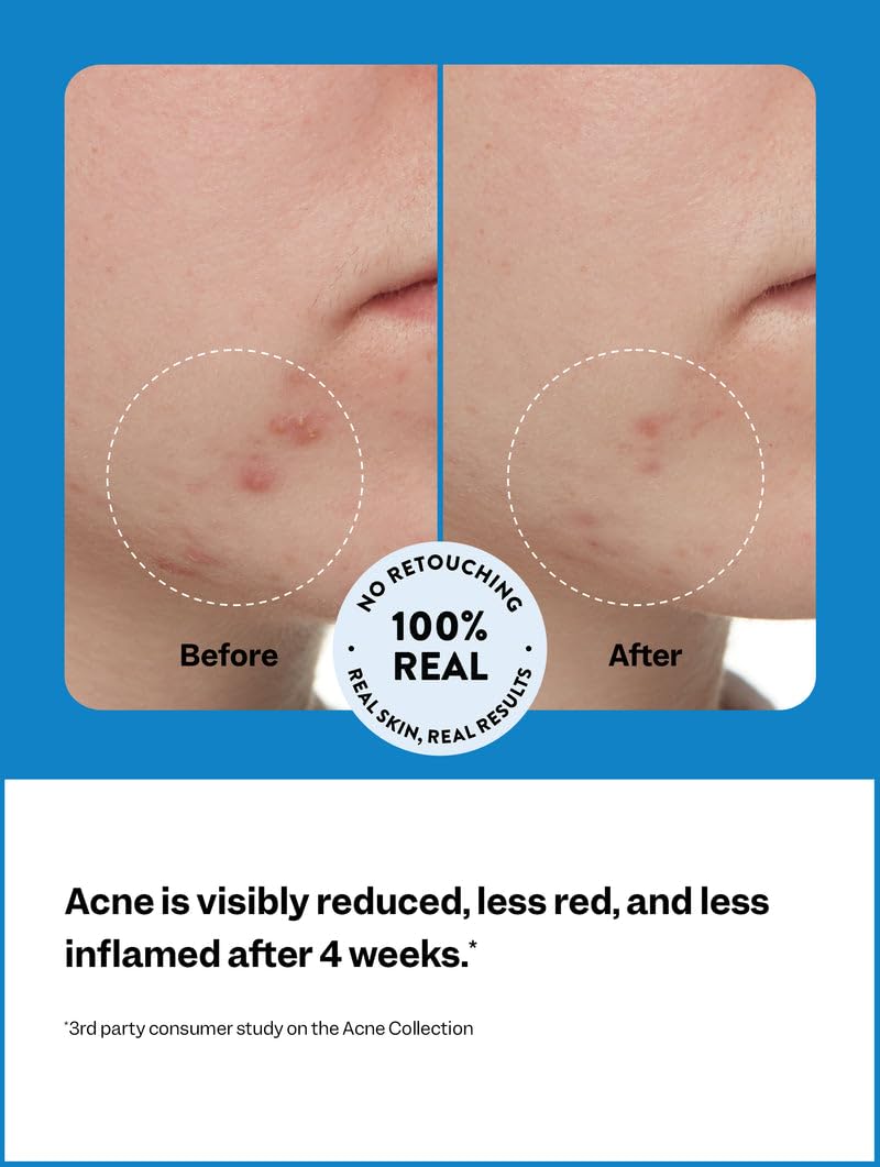 Peach Slices 3-Step Acne Starter Kit